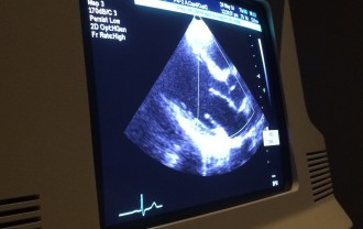 Aurora's heart beating in an echocardiogram