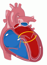 drawing of a human heart suffering from wolf parkinson white, with alternate pathway in yellow