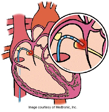 a cartoon heart showing a catheter ablating an extra pathway from Wolff-Parkinson-White