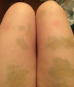 Aurora's bruised legs after the Spartan Trifecta-in-a-day Obstacle Mud Run 2014